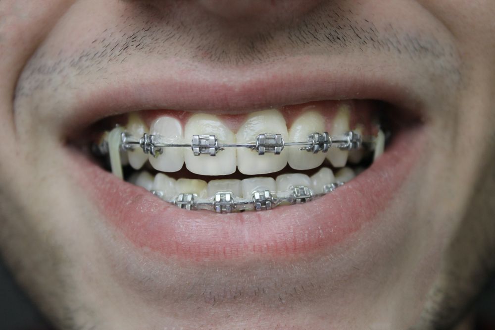 Smil til verden: En reise gjennom tannregulering